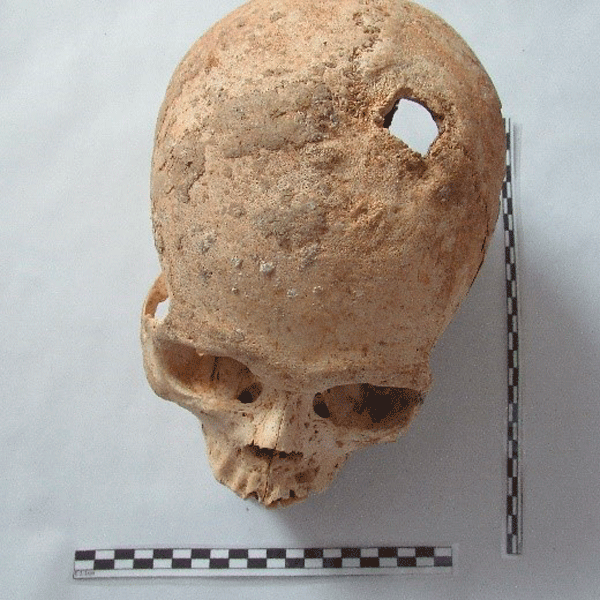 About a prehispanic cranial trepanation in the eastern foothills of the central mountain range of Colombia, Planadas - Tolima